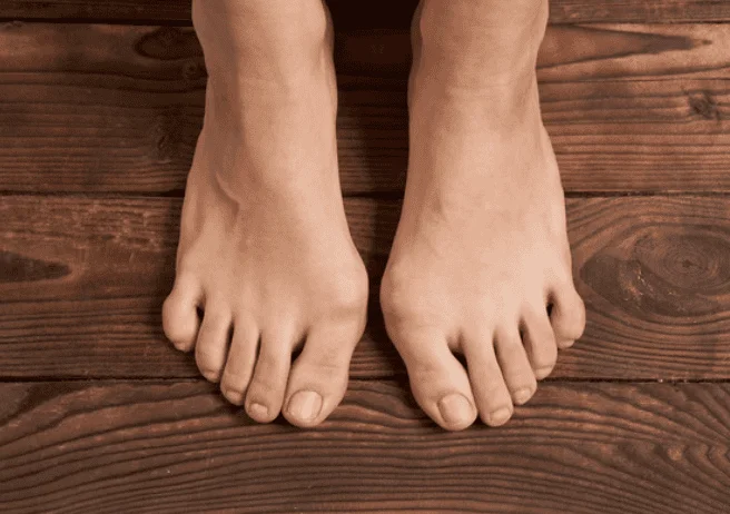 Bunion at the base of the big toe