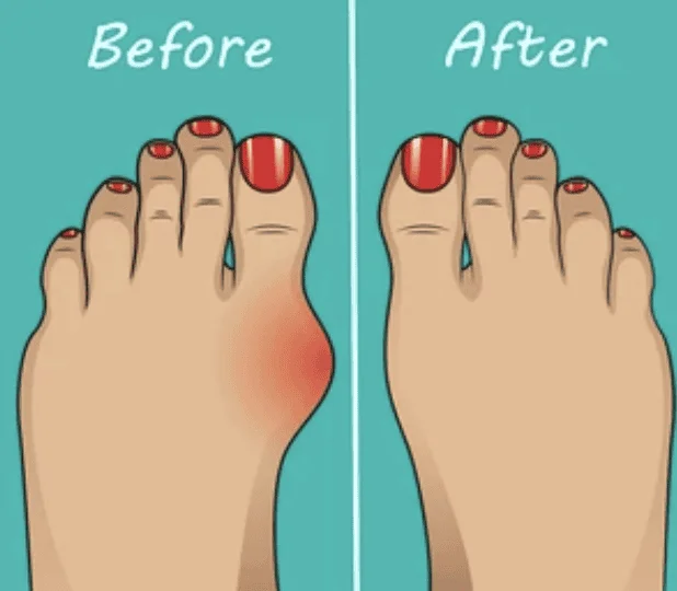 Understanding Bunions